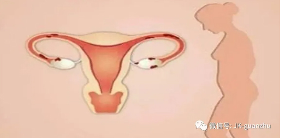 女性子宫切除以后会有哪些影响？